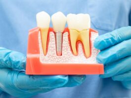 Is It Painful to Extract a Root Canal Tooth