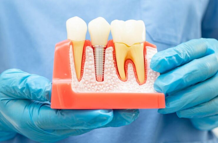 Is It Painful to Extract a Root Canal Tooth